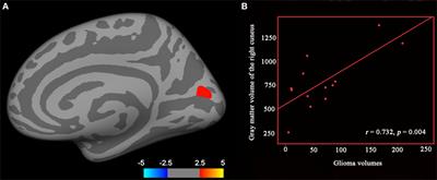 Cortical and Subcortical Structural Plasticity Associated with the Glioma Volumes in Patients with Cerebral Gliomas Revealed by Surface-Based Morphometry